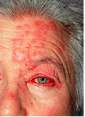 Ophthalmic Herpes Zoster Rash